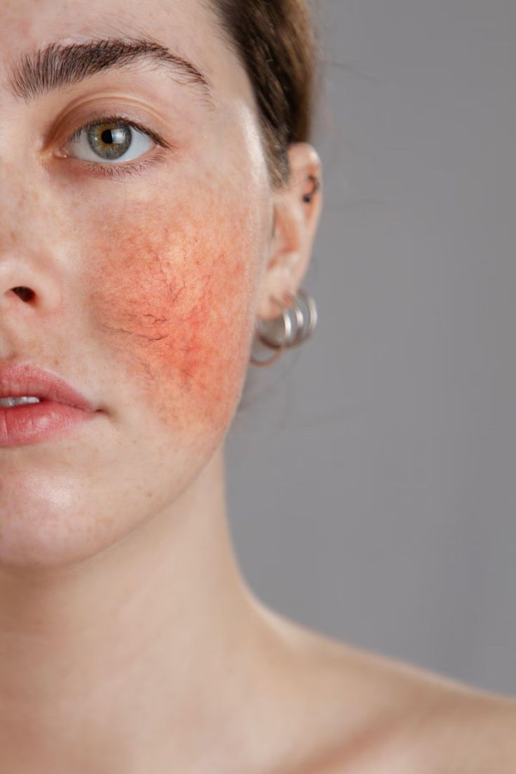 Aerolase® Rosacea and Redness | 4 Sessions