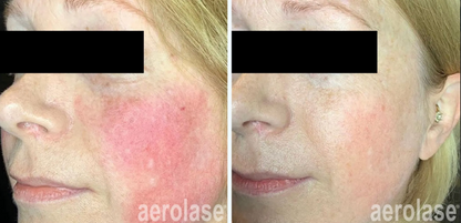 Aerolase® Rosacea and Redness | 6 Sessions