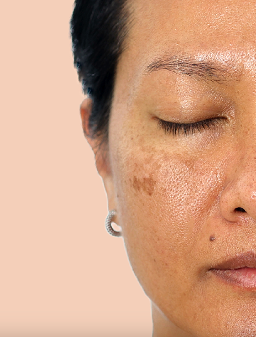 Aerolase® MELASMA + SUN SPOTS | 4 Sessions